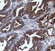 IHC staining of FFPE human colorectal adenocarcinoma tissue with IFT52 antibody. HIER: boil tissue sections in pH8 EDTA for 20 min and allow to cool before testing.