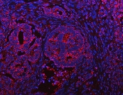 Immunofluorescent staining of FFPE human intestinal cancer tissue with IFT52 antibody (red) and DAPI nuclear stain (blue). HIER: steam section in pH8 EDTA buffer for 20 min.