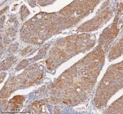 IHC staining of FFPE human liver cancer tissue with SHKBP1 antibody. HIER: boil tissue sections in pH8 EDTA for 20 min and allow to cool before testing.