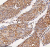 IHC staining of FFPE human liver cancer tissue with SHKBP1 antibody. HIER: boil tissue sections in pH8 EDTA for 20 min and allow to cool before testing.