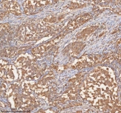 IHC staining of FFPE human lung adenocarcinoma tissue with SHKBP1 antibody. HIER: boil tissue sections in pH8 EDTA for 20 min and allow to cool before testing.