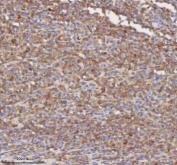 IHC staining of FFPE diffuse large B-cell lymphoma of human intestine tissue with SHKBP1 antibody. HIER: boil tissue sections in pH8 EDTA for 20 min and allow to cool before testing.