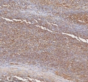 IHC staining of FFPE diffuse large B-cell lymphoma of human intestine tissue with SHKBP1 antibody. HIER: boil tissue sections in pH8 EDTA for 20 min and allow to cool before testing.