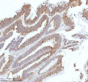 IHC staining of FFPE human colon adenocarcinoma tissue with HAGH antibody. HIER: boil tissue sections in pH8 EDTA for 20 min and allow to cool before testing.