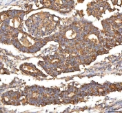 IHC staining of FFPE human colon adenocarcinoma tissue with ITPA antibody. HIER: boil tissue sections in pH8 EDTA for 20 min and allow to cool before testing.