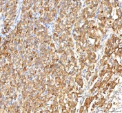 IHC staining of FFPE human lung cancer tissue with ITPA antibody. HIER: boil tissue sections in pH8 EDTA for 20 min and allow to cool before testing.