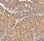 IHC staining of FFPE human liver cancer tissue with ITPA antibody. HIER: boil tissue sections in pH8 EDTA for 20 min and allow to cool before testing.