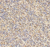 IHC staining of FFPE human glioblastoma tissue with ITPA antibody. HIER: boil tissue sections in pH8 EDTA for 20 min and allow to cool before testing.