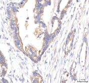 IHC staining of FFPE human pancreas ductal adenocarcinoma tissue with HEPACAM2 antibody. HIER: boil tissue sections in pH8 EDTA for 20 min and allow to cool before testing.