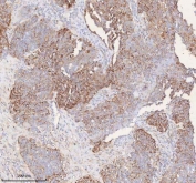 IHC staining of FFPE human ovarian cancer tissue with SLC6A20 antibody. HIER: boil tissue sections in pH8 EDTA for 20 min and allow to cool before testing.