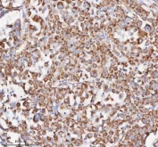 IHC staining of FFPE human lung adenocarcinoma tissue with SLC6A20 antibody. HIER: boil tissue sections in pH8 EDTA for 20 min and allow to cool before testing.