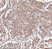 IHC staining of FFPE human lung adenocarcinoma tissue with SLC6A20 antibody. HIER: boil tissue sections in pH8 EDTA for 20 min and allow to cool before testing.
