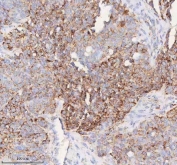 IHC staining of FFPE human ovarian cancer tissue with SLC6A20 antibody. HIER: boil tissue sections in pH8 EDTA for 20 min and allow to cool before testing.