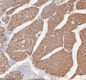 IHC staining of FFPE human liver cancer tissue with SLC6A20 antibody. HIER: boil tissue sections in pH8 EDTA for 20 min and allow to cool before testing.