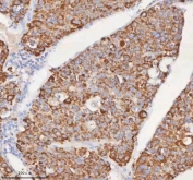 IHC staining of FFPE human liver cancer tissue with SLC6A20 antibody. HIER: boil tissue sections in pH8 EDTA for 20 min and allow to cool before testing.