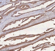 IHC staining of FFPE human rectum adenocarcinoma tissue with SLC6A20 antibody. HIER: boil tissue sections in pH8 EDTA for 20 min and allow to cool before testing.