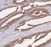 IHC staining of FFPE human rectum adenocarcinoma tissue with SLC6A20 antibody. HIER: boil tissue sections in pH8 EDTA for 20 min and allow to cool before testing.