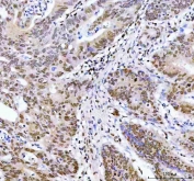 IHC staining of FFPE human colorectal adenocarcinoma tissue with ARID domain-containing protein 1A antibody. HIER: boil tissue sections in pH8 EDTA for 20 min and allow to cool before testing.