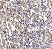 IHC staining of FFPE human breast cancer tissue with RASGRP3 antibody. HIER: boil tissue sections in pH8 EDTA for 20 min and allow to cool before testing.