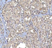 IHC staining of FFPE human thyroid cancer tissue with RASGRP3 antibody. HIER: boil tissue sections in pH8 EDTA for 20 min and allow to cool before testing.