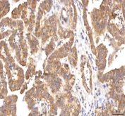 IHC staining of FFPE human thyroid papillary carcinoma tissue with PCMT1 antibody. HIER: boil tissue sections in pH8 EDTA for 20 min and allow to cool before testing.