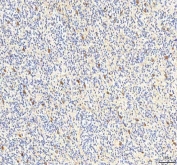 IHC staining of FFPE human glioblastoma tissue with PCMT1 antibody. HIER: boil tissue sections in pH8 EDTA for 20 min and allow to cool before testing.