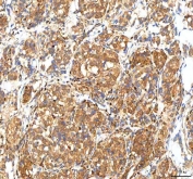 IHC staining of FFPE human lung cancer tissue with ISYNA1 antibody. HIER: boil tissue sections in pH8 EDTA for 20 min and allow to cool before testing.