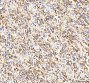IHC staining of FFPE human glioblastoma tissue with ISYNA1 antibody. HIER: boil tissue sections in pH8 EDTA for 20 min and allow to cool before testing.
