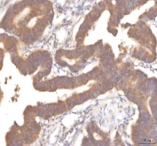 IHC staining of FFPE human colon adenocarcinoma tissue with MFSD12 antibody. HIER: boil tissue sections in pH8 EDTA for 20 min and allow to cool before testing.