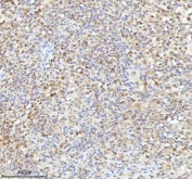 IHC staining of FFPE diffuse large B-cell lymphoma of human intestine tissue with METTL18 antibody. HIER: boil tissue sections in pH8 EDTA for 20 min and allow to cool before testing.