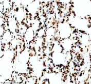 IHC staining of FFPE human breast cancer tissue with Phospho-MDM2 antibody, HRP-secondary and DAB substrate. HIER: boil tissue sections in pH8 EDTA for 20 min and allow to cool before testing.