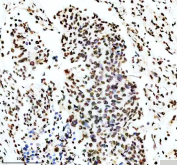 IHC staining of FFPE human lung cancer tissue with Phospho-MDM2 antibody, HRP-secondary and DAB substrate. HIER: boil tissue sections in pH8 EDTA for 20 min and allow to cool before testing.