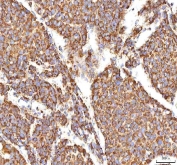 IHC staining of FFPE human liver cancer tissue with CALR antibody. HIER: boil tissue sections in pH8 EDTA for 20 min and allow to cool before testing.