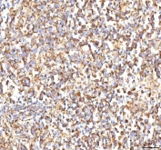 IHC staining of FFPE human testicular seminoma tissue with CALR antibody. HIER: boil tissue sections in pH8 EDTA for 20 min and allow to cool before testing.