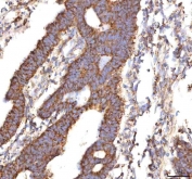 IHC staining of FFPE human colon adenocarcinoma tissue with CALR antibody. HIER: boil tissue sections in pH8 EDTA for 20 min and allow to cool before testing.