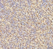 IHC staining of FFPE human glioblastoma tissue with CALR antibody. HIER: boil tissue sections in pH8 EDTA for 20 min and allow to cool before testing.