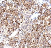 IHC staining of FFPE human lung cancer tissue with CALR antibody. HIER: boil tissue sections in pH8 EDTA for 20 min and allow to cool before testing.