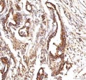 IHC staining of FFPE human pancreas ductal adenocarcinoma tissue with CALR antibody. HIER: boil tissue sections in pH8 EDTA for 20 min and allow to cool before testing.