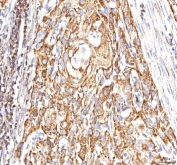 IHC staining of FFPE human urothelial carcinoma tissue with CALR antibody. HIER: boil tissue sections in pH8 EDTA for 20 min and allow to cool before testing.
