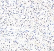 IHC staining of FFPE human urothelial carcinoma tissue with IPO8 antibody. HIER: boil tissue sections in pH8 EDTA for 20 min and allow to cool before testing.