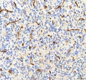 IHC staining of FFPE human glioblastoma tissue with Pyridoxal kinase antibody. HIER: boil tissue sections in pH8 EDTA for 20 min and allow to cool before testing.