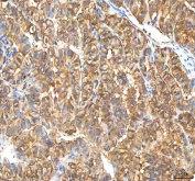 IHC staining of FFPE human thyroid papillary carcinoma tissue with Pyridoxal kinase antibody. HIER: boil tissue sections in pH8 EDTA for 20 min and allow to cool before testing.