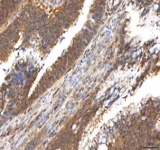 IHC staining of FFPE human colon adenocarcinoma tissue with Pyridoxal kinase antibody. HIER: boil tissue sections in pH8 EDTA for 20 min and allow to cool before testing.