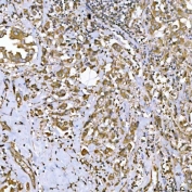 IHC staining of FFPE human breast cancer tissue with GlnRS antibody. HIER: boil tissue sections in pH8 EDTA for 20 min and allow to cool before testing.