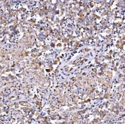 IHC staining of FFPE human testicular seminoma tissue with GlnRS antibody. HIER: boil tissue sections in pH8 EDTA for 20 min and allow to cool before testing.
