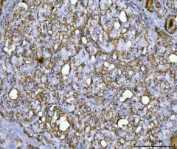 IHC staining of FFPE human thyroid cancer tissue with GlnRS antibody. HIER: boil tissue sections in pH8 EDTA for 20 min and allow to cool before testing.
