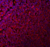 Immunofluorescent staining of FFPE human testicular cancer tissue with GlnRS antibody (red) and DAPI nuclear stain (blue). HIER: steam section in pH8 EDTA buffer for 20 min.