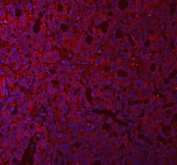 Immunofluorescent staining of FFPE human thyroid carcinoma tissue with GlnRS antibody (red) and DAPI nuclear stain (blue). HIER: steam section in pH8 EDTA buffer for 20 min.