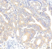 IHC staining of FFPE human colon adenocarcinoma tissue with Plakophilin 2 antibody. HIER: boil tissue sections in pH8 EDTA for 20 min and allow to cool before testing.