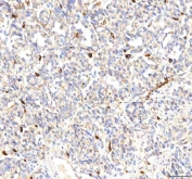 IHC staining of FFPE human lung cancer tissue with Plakophilin 2 antibody. HIER: boil tissue sections in pH8 EDTA for 20 min and allow to cool before testing.